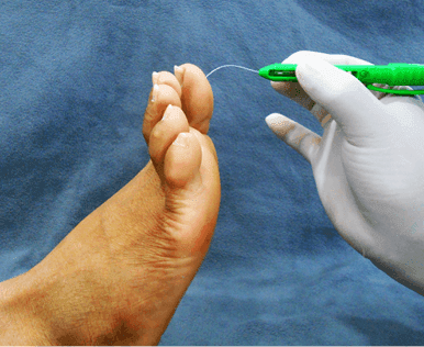 Diabetes foot assessment