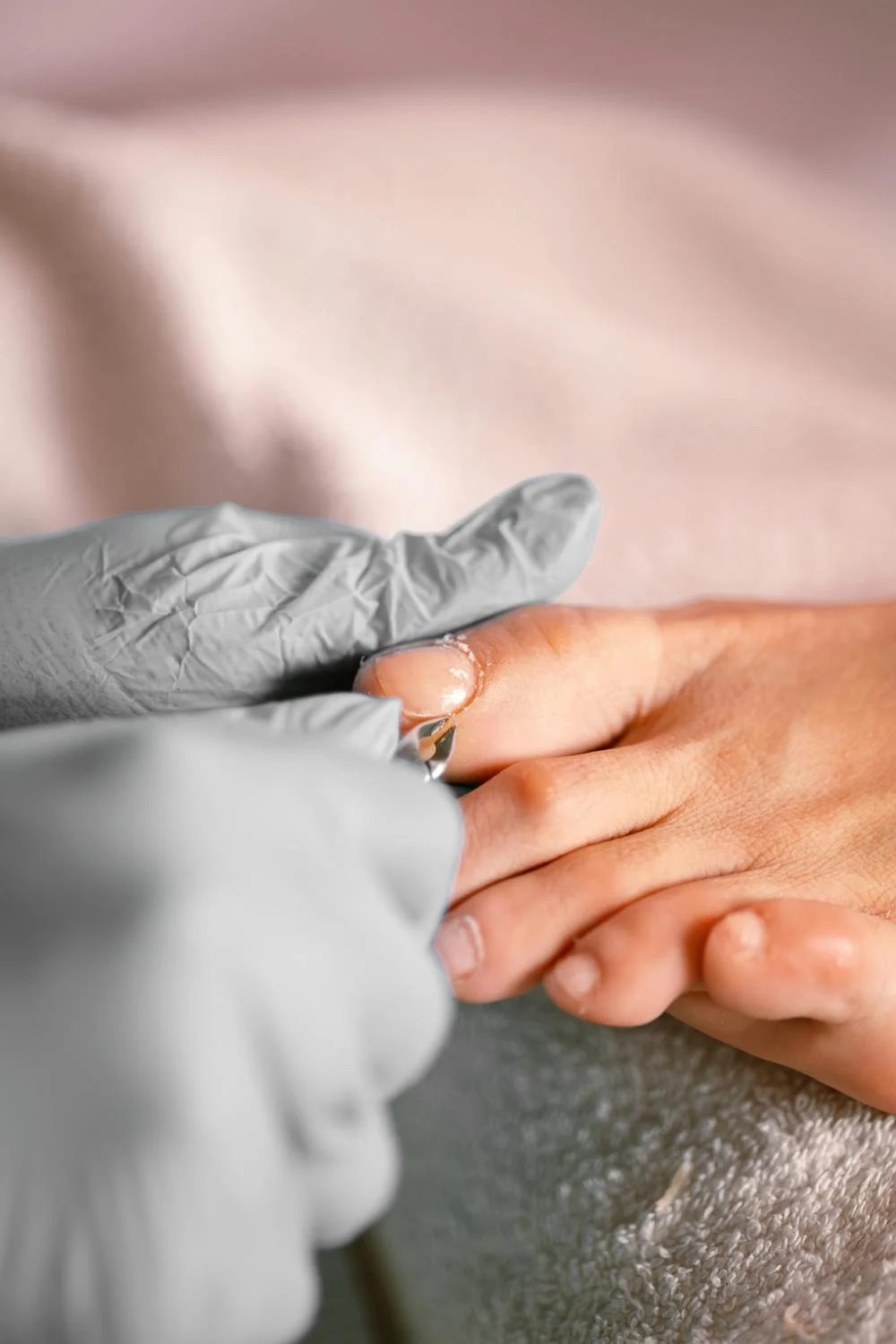 Ingrown toenail care